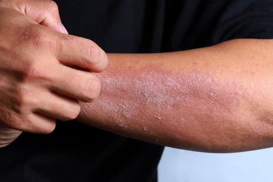 Dry Skin Tips, Prevention, and Causes
