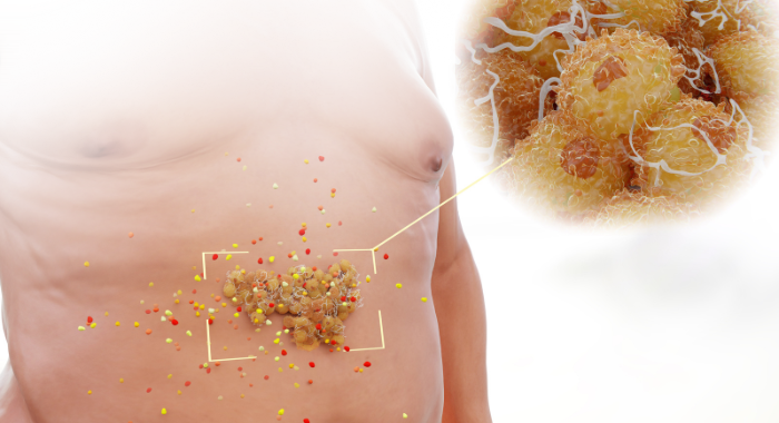 Visceral Fat: A Marker for Systemic Inflammation